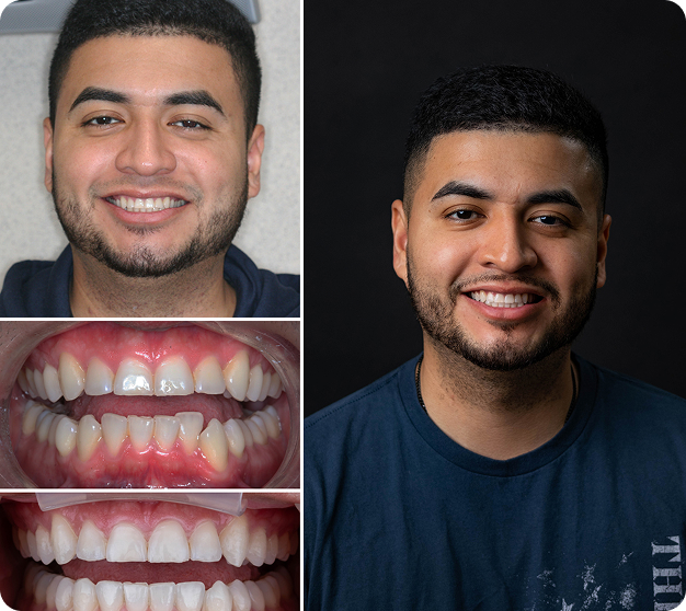 Alexis Before & After