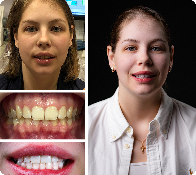 Anna Before & After
