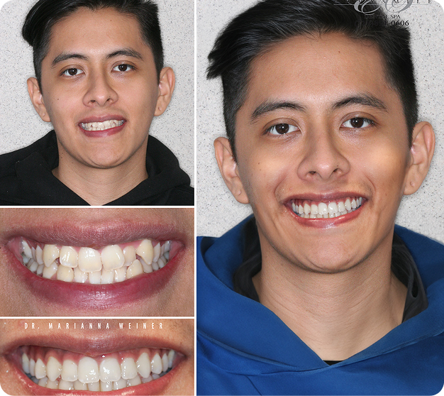Johann Before & After