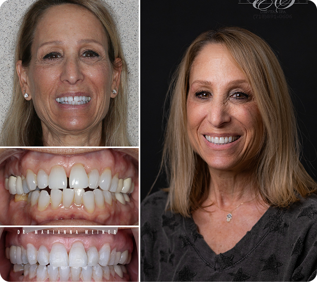 Laurie Before & After