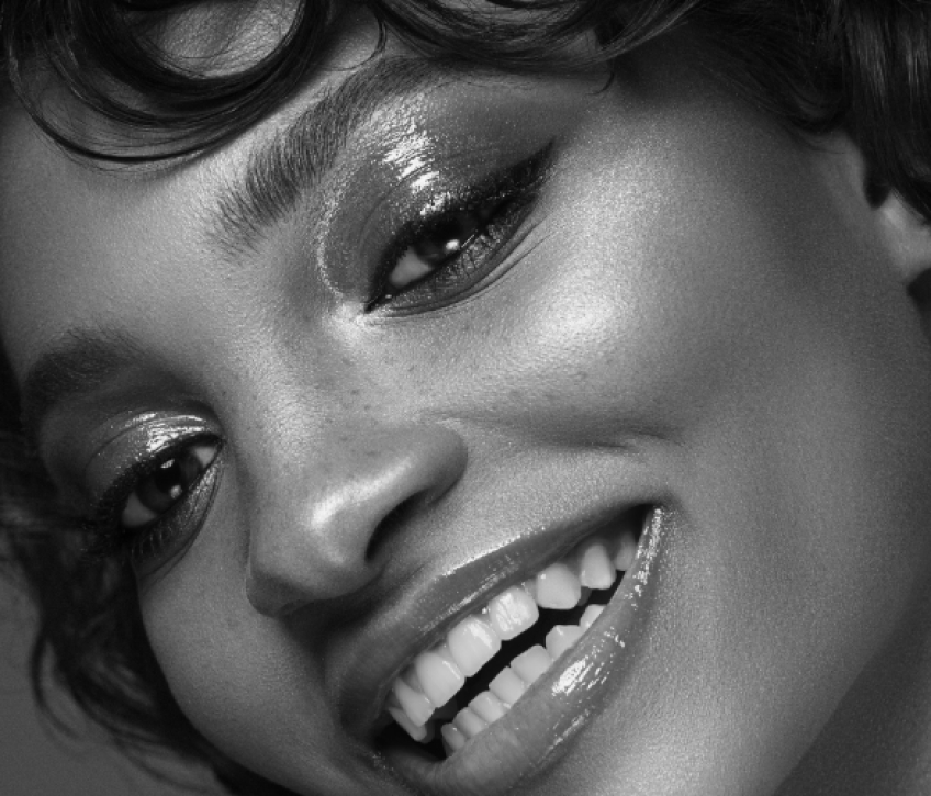 Post Invisalign Treatment Result