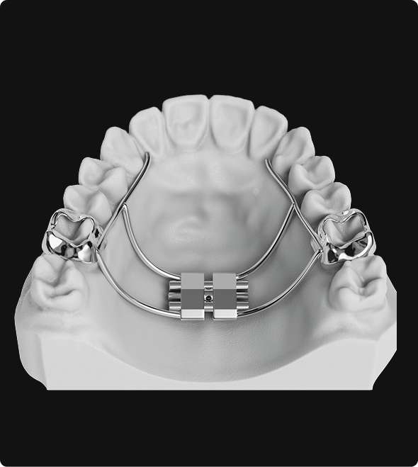 Palatal Expander