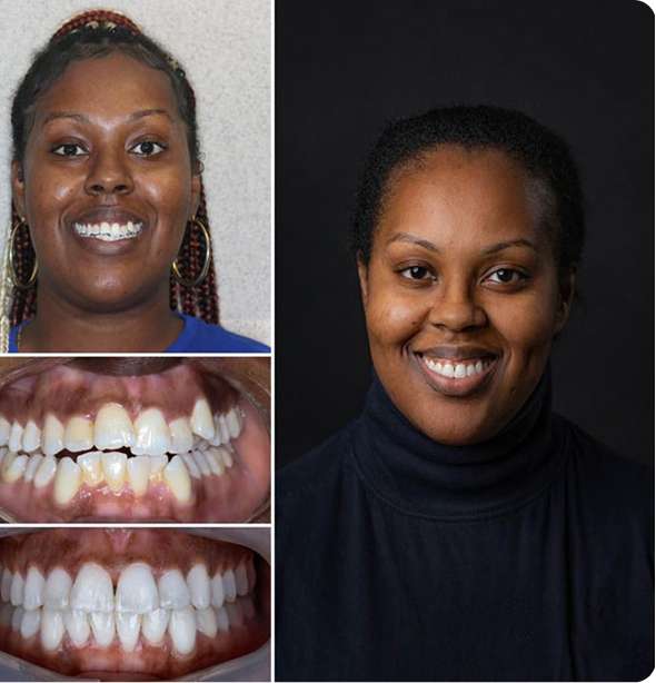 invisalign Before & After