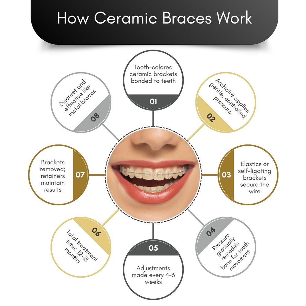 How Ceramic Braces Work