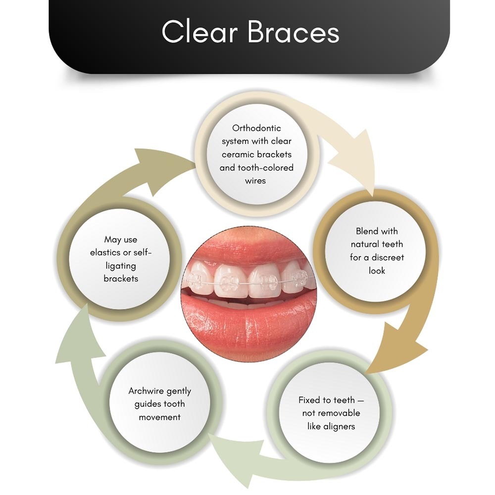 Clear Braces in Brooklyn