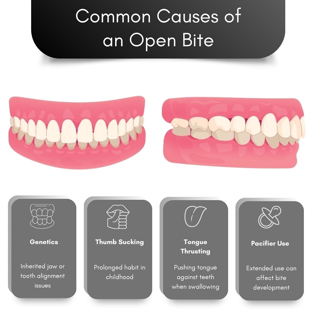 Common Causes of An Open Bite
