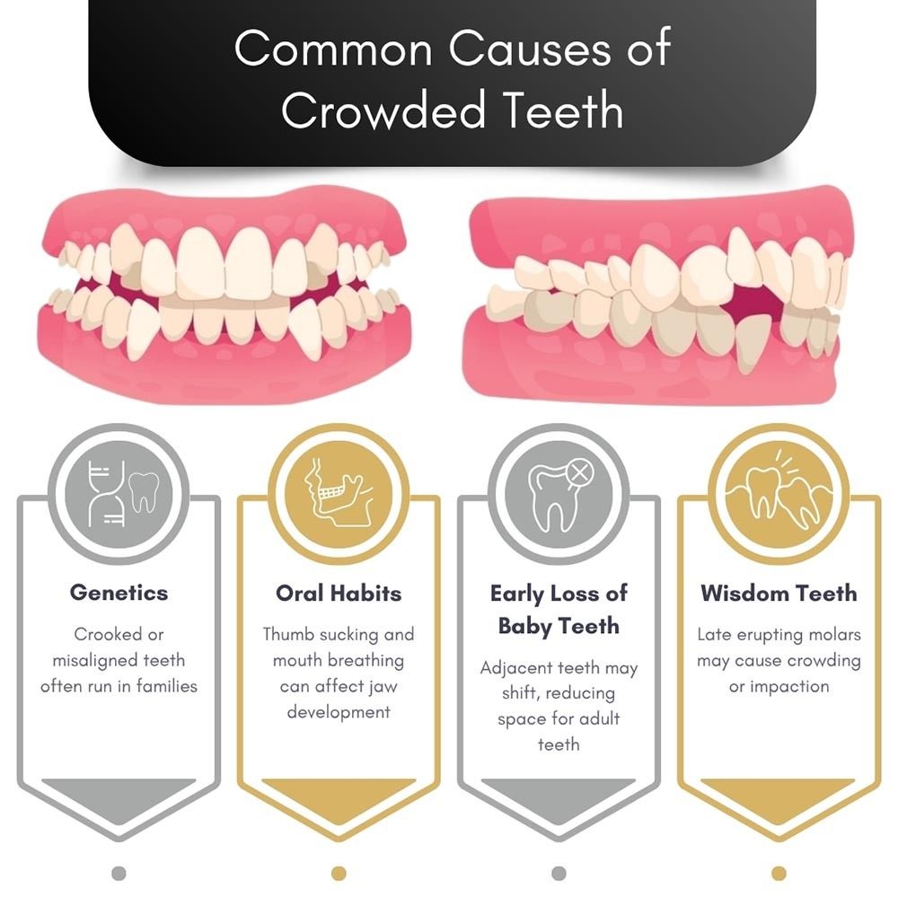 Common Causes of Crowded Teeth