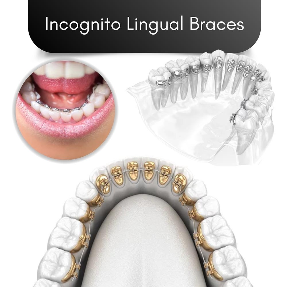 Incognit Lingual Braces in Brooklyn