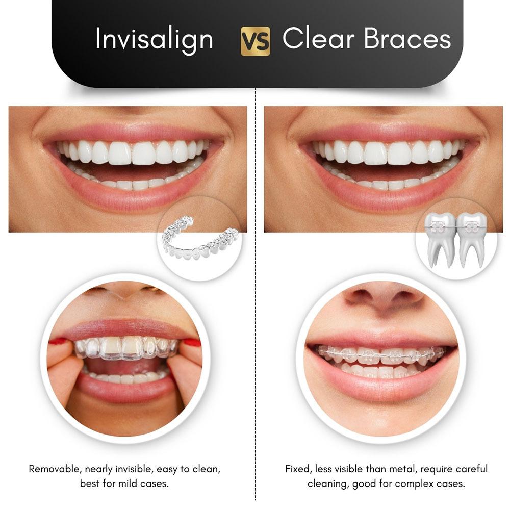 Invisalign vs Clear Braces Comparison Brooklyn