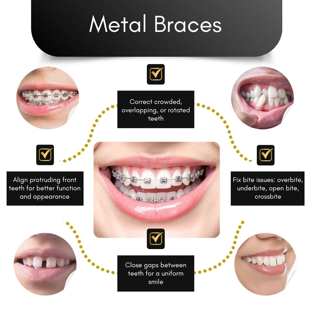 Metal Braces in Brooklyn
