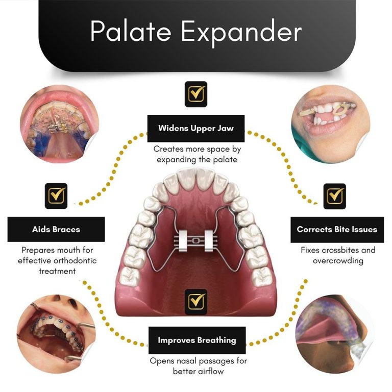 Palate Expander Brooklyn, NY