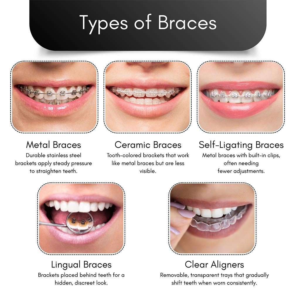 Types of Braces in Brooklyn