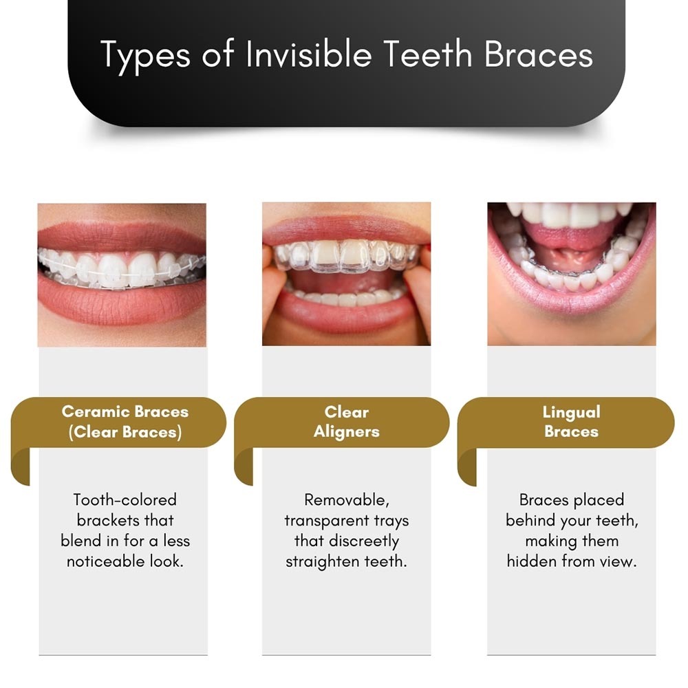 Types of Invisible Teeth Braces