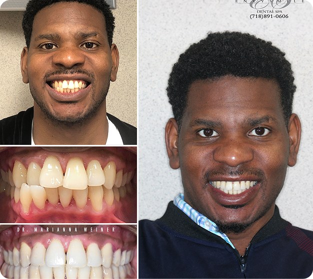 Pascal Before & After